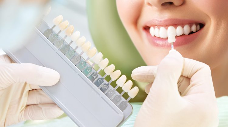 Close-up of a dentist holding a shade guide next to a patient's teeth to match the color for dental veneers or crowns, showcasing a bright and healthy smile.